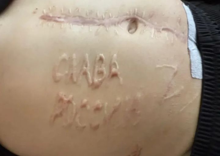 [뉴시스] 러시아에 포로로 잡혔다가 풀려난 우크라이나 군인의 복부에 '러시아에 영광을'이라는 문구가 새겨져 있었다는 사실이 알려졌다. (사진=막심 투르케비치 페이스북) *재판매 및 DB 금지