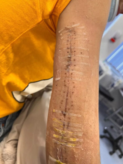 [서울=뉴시스] 영국 베드퍼드셔주 던스터블에 거주하며 빵 공장에서 근무하는 마달리나 치리카(28·여)는 지난 2023년 2월 근무 중 컨베이어 벨트에 오른팔이 끼이는 사고를 당했다. (사진=더 미러 캡처) 2025.06.23 *재판매 및 DB 금지