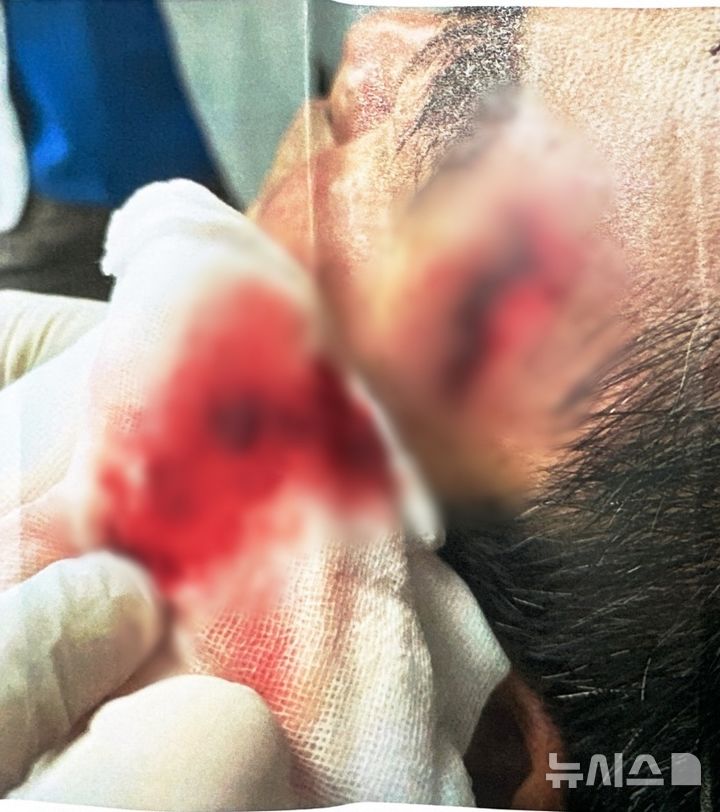 [단양=뉴시스] B씨가 부상입은 부위 (사진= 독자 제공) 2025.06.24. photo@newsis.com *재판매 및 DB 금지