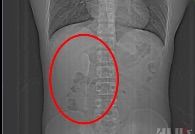[뉴시스] 중국의 한 20대 남성의 뱃속에서 티스푼이 6개월 만에 발견됐다. (사진=신랑재경 영상 캡처) 2025.6.25 *재판매 및 DB 금지