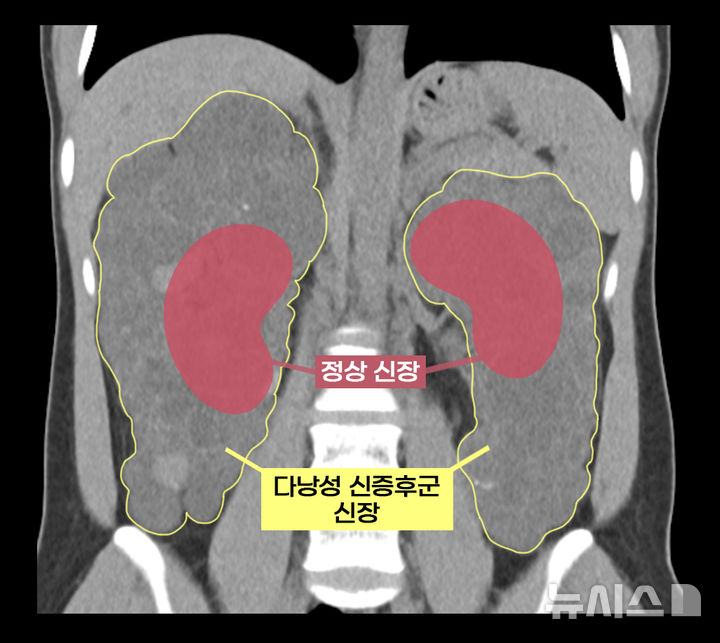 [서울=뉴시스]다낭성 신증후군 환자의 신장과 정상 신장 비교. (이미지= 서울아산병원 제공) 2025.06.30. photo@newsis.com. 