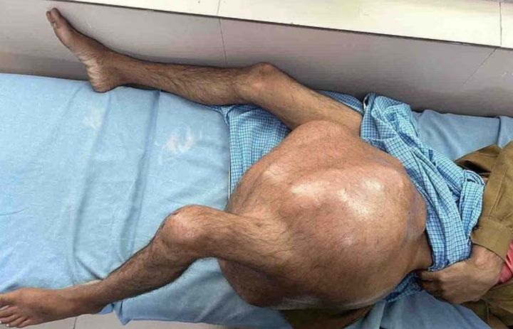 [서울=뉴시스] 인도 우타르프라데시에 거주하는 모하메드 살만(27)은 지난달 9일 왼쪽 허벅지에서 약 35kg의 암 종양을 제거했다. (사진=데일리메일 캡처) 2025.07.03 *재판매 및 DB 금지