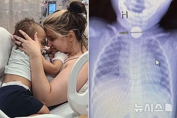[서울=뉴시스]병원이 오진한 18개월 아이가 배터리를 삼킨 사실이 확인돼 긴급 수술로 목숨을 건졌다. (사진=Kennedy News & Media) 2025.7.2. 