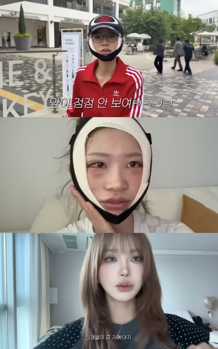 [서울=뉴시스] 최준희가 지난 8일 유튜브 채널 '준희'에 안면 윤곽, 눈 밑 뒷트임 성형수술 후기를 밝혔다. (사진=유튜브 채널 '준희' 캡처) 2025.07.11. photo@newsis.com *재판매 및 DB 금지