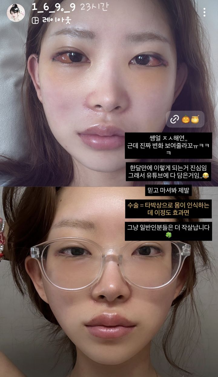[서울=뉴시스] 인플루언서 최준희가 안면 윤곽, 눈 성형수술 전후 모습을 공개했다. (사진=최준희 인스타그램 캡처) 2025.07.11. photo@newsis.com *재판매 및 DB 금지