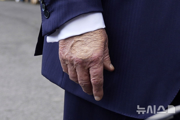 [워싱턴=AP/뉴시스] 지난 15일(현지 시간) 도널드 트럼프 대통령이 백악관에서 기자들과 질의응답을 하고 있는 가운데 손에 멍 자국을 가리기 위한 화장품이 덧발려져 있다. 올해 79세인 트럼프 대통령이 종아리 붓는 증상으로 종합 검진한 결과 만성 정맥부전을 진단받았다. 2025.07.18.