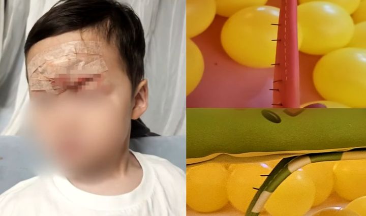 [서울=뉴시스] A씨는 "일반 봉합이 불가능한 부위라 성형외과에서 전문 수술을 받았다"며 "경과를 지켜봐야 알겠지만 수술 후에도 흉터가 남을 거라는 병원 소견을 받았다"고 말했다. (사진=JTBC '사건반장' 갈무리) 2025.07.21 *재판매 및 DB 금지