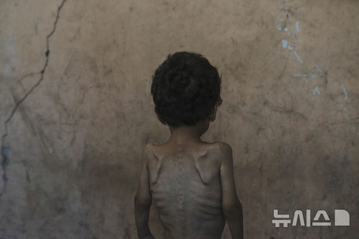 [가자시티=AP/뉴시스] 23일(현지 시간) 가자시티 샤티 난민 캠프에 머물고 있는 야잔 아부 풀(2)의 모습. 굶주림으로 인해 뼈가 드러나고 앙상한 모습이다. 2025.07.25.
