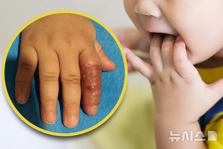 [서울=뉴시스] 잘못된 육아 팁을 따라 아이의 손가락을 붕대로 묶은 결과, 아이의 손가락은 괴사 직전까지 부어오르고 변색됐다.(사진=사우스차이나모닝포스트) 