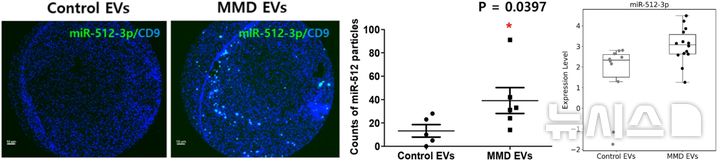 [서울=뉴시스] 모야모야병 환자(MMD)와 정상 대조군(Control)의 혈장에서 분리한 세포외소포 내 miRNA를 분석한 결과 환자군에서 'miR-512-3p'의 발현이 유의미하게 높은 것으로 나타났다. (사진= 서울대병원 제공)