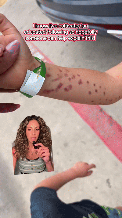 [뉴시스] 수족관에 갔다가 문어에게 팔을 잡혀 멍이 든 미국 6세 아이의 모습. (영상=브리트니 타린 틱톡) 2025.8.3 *재판매 및 DB 금지