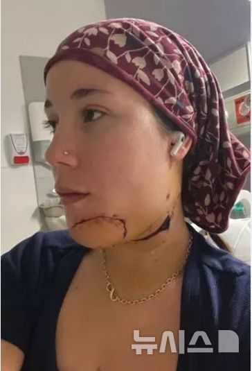 [서울=뉴시스]영국의 23살 비아 처칠이 턱 재건 수술을 위해 허벅지 피부를 이식한 후 털이 자라나 고통을 호소하고 있다. 22025.08.04. (사진=영국 인터넷매체 SWNS)