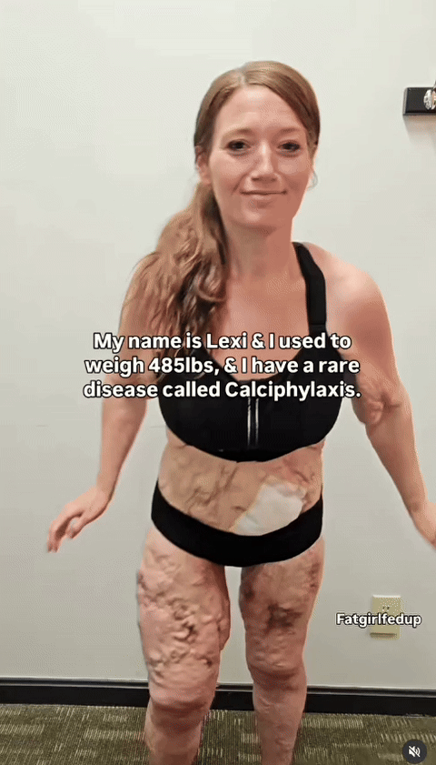 [뉴시스]31일(현지시각) 더선에 따르면 렉시 리드(34)는 친구의 권유로 체중 감량을 결심한 뒤 2년간 철저한 운동과 식단 조절만으로 140kg 이상을 감량하는 데 성공했다. 하지만 이후 희귀병인 칼시필락시스(Calciphylaxis) 진단을 받았다. 그녀는 감량 후 희귀질환 투병 중에도 건강을 위해 운동을 지속하는 영상을 게시했다. (사진=인스타그램) *재판매 및 DB 금지