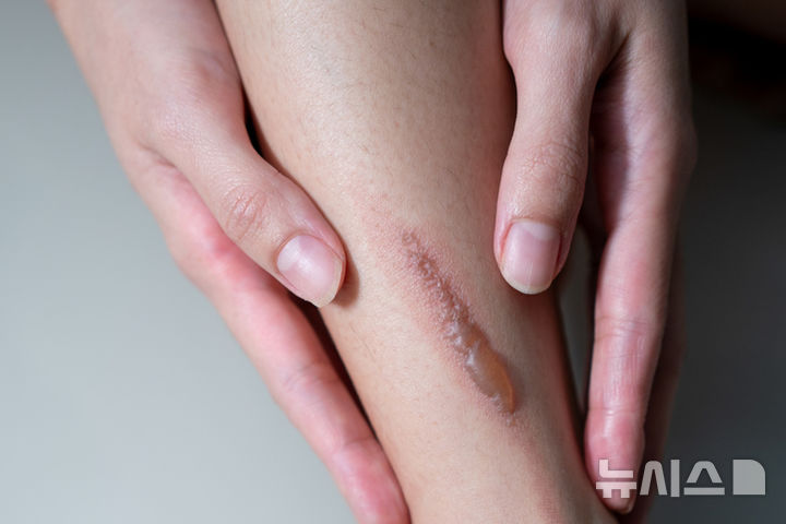 [서울=뉴시스] 비대성 흉터. (사진= 게티이미지 뱅크 제공)