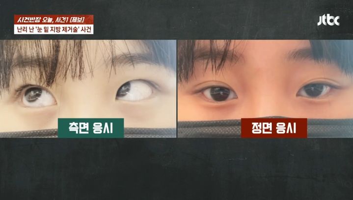 [뉴시스] A씨의 눈. (출처=JTBC '사건반장') *재판매 및 DB 금지