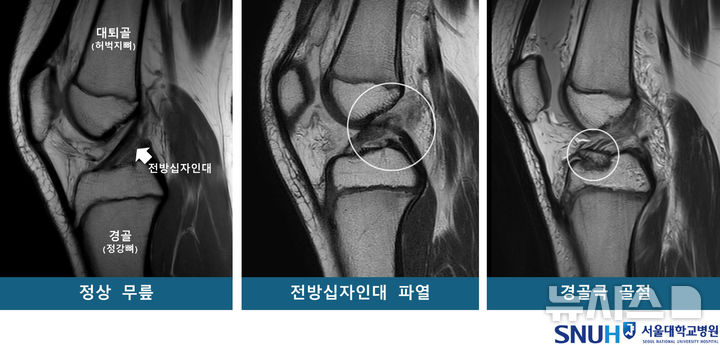 [서울=뉴시스] 정상 무릎 및 무릎 부상 환자의 MRI. (사진= 서울대병원 제고얘