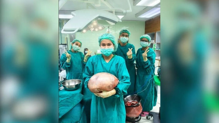 [서울=뉴시스]한 여성의 배에서 8㎏ 종양이 발견돼 큰 논라움을 주고있다.(사진=페이스북(Dr. Thamon Satun's obstetrics clinic)).2025.08.08. *재판매 및 DB 금지