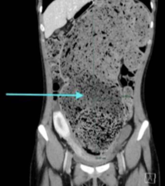 [뉴시스] 만성변비를 방치하다가 장이 비정상적으로 늘어나 굳은 대변을 직접 제거하는 수동 박리술을 받은 한 미국 여성의 사연이 알려졌다. (사진 = 더선 캡처) 2025.08.11. *재판매 및 DB 금지