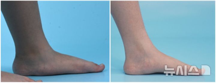 [서울=뉴시스] '종골 정지술'을 받은 12세 환아의 수술 전(좌)과 수술 3년 후(우) 발 사진. 수술 후 발의 정렬이 정상에 가깝게 교정됐으며, 아치 또한 회복돼 평발 변형이 효과적으로 교정된 모습을 확인할 수 있다. (사진= 분당서울대병원 제공)