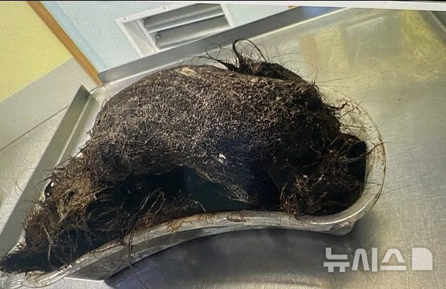 [뉴시스] 의사들이 에린의 위 속에서 꺼낸 머리카락 (출처=데일리메일) 