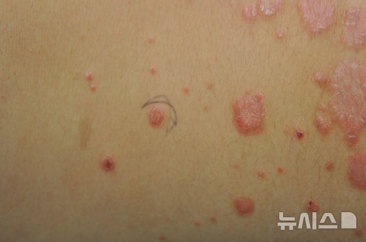 [서울=뉴시스] 등 부위에 건선이 나타난 모습. (사진= 한림대의료원 제공)