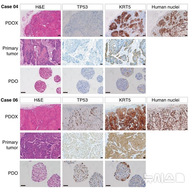 [서울=뉴시스] 연구팀이 다양한 유전자 돌연변이를 동반한 두경부암 오가노이드 배양에 성공했음을 보여주는 두경부암 오가노이드 라이브러리. (사진= 연세대학교 강남세브란스병원 제공)