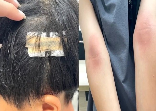 [서울=뉴시스] 놀이기구 오작동으로 다친 초등학생 (사진=JTBC 사건반장 갈무리) 2025.08.13 *재판매 및 DB 금지