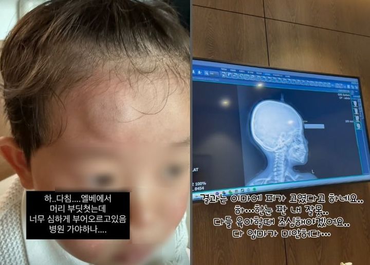 [서울=뉴시스] 배우 김보미가 아들의 갑작스러운 부상 소식을 전하며 안타까운 마음을 드러냈다. (사진=김보미 인스타그램 캡처) 2025.08.13. photo@newsis.com *재판매 및 DB 금지