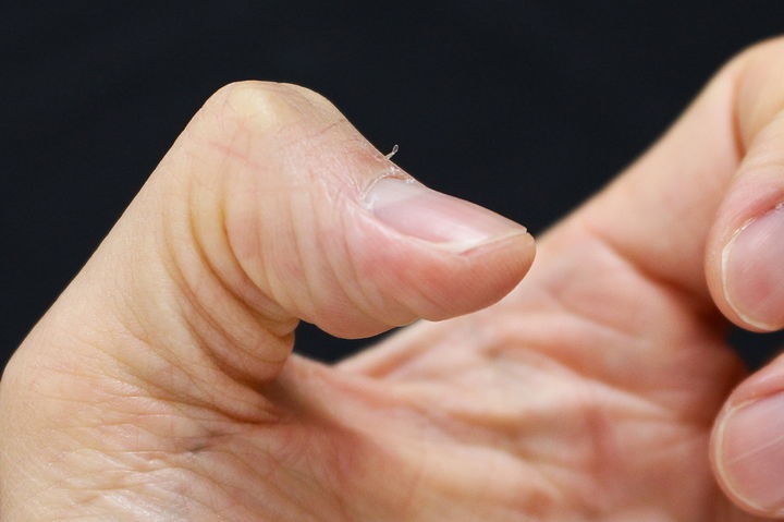 [서울=뉴시스] 15일 의료계에 따르면 생인손이라고도 불리는 조갑주위염은 손톱, 발톱 주변이 붓고 염증이 생기는 질환을 말한다. (사진=고대안산병원 제공) 2025.08.14. photo@newsis.com *재판매 및 DB 금지