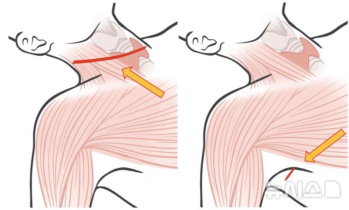 [서울=뉴시스] 왼쪽부터 측경부임파선곽청술의 개경술 절개 부위, GOSTA 절개 부위. (사진= 고대안산병원 제공)