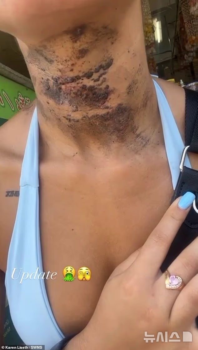 [뉴시스] 목에 화상을 입어 검게 그을린 자국. (사진=데일리메일)