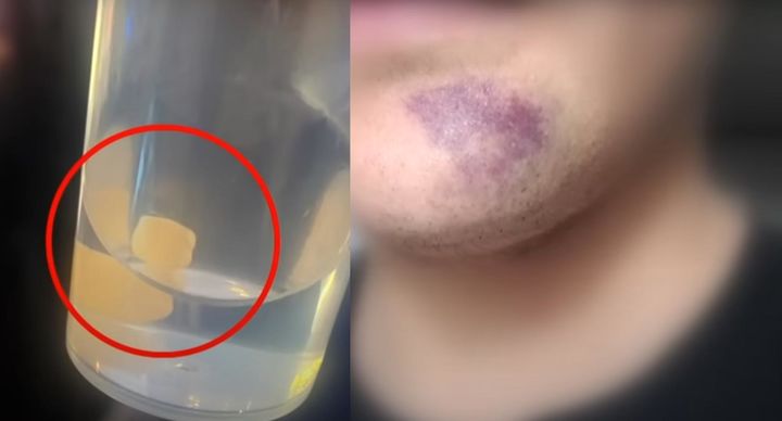 [서울=뉴시스] 피해 직원의 부러진 치아(왼쪽)와 턱의 모습. (사진 = 'JTBC News' 유튜브 갈무리) 2025.08.20. *재판매 및 DB 금지