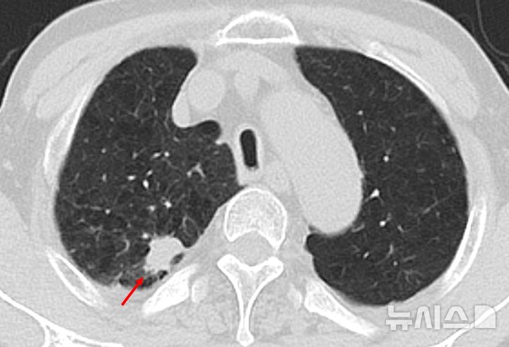 [서울=뉴시스] 저선량 흉부 CT 검사에서 폐결절 확인 사진. (사진= 한림대동탄성심병원 제공)