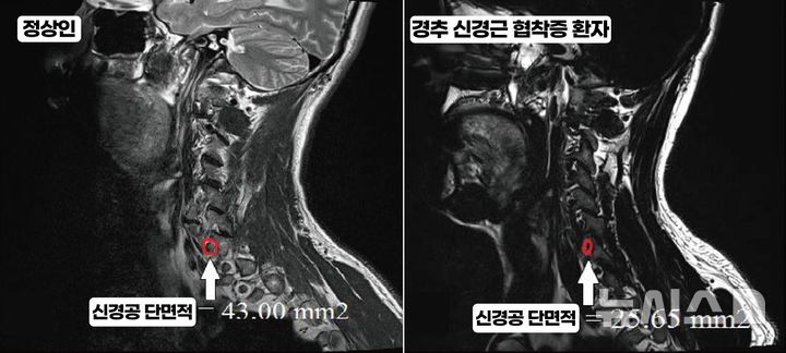 [인천=뉴시스] 정상인과 경추협착증 환자의 신경공 단면적 비교. (사진=국제성모병원 제공) 2025.08.21. photo@newsis.com