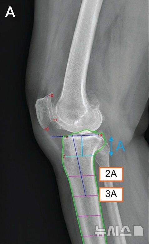 [서울=뉴시스]&nbsp; 딥러닝 모델의 측정 매커니즘. 6개의 해부학적 기준점(빨간 점)을 자동 인식한 후, 경골의 관절선과 중심축(파란 선)을 결정해 경골 후방 기울기를 계산한다. (사진= 서울대병원 제공)