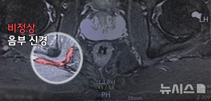 [서울=뉴시스] 비정상 음부신경. (사진= 한림대학교의료원 제공)&nbsp; 