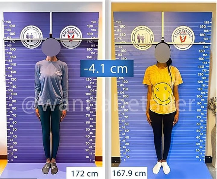 [뉴시스] 키 큰 여성들이 연애의 가능성과 다리길이 불균형을 바로잡기 위해 키 줄이는 수술을 받았다.(사진=데일리 메일) *재판매 및 DB 금지