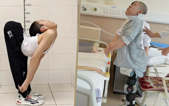 [뉴시스] 허리가 굽어 '접힌 소년'이라고 불린 중국의 한 청년이 수술 후 허리를 펼 수 있게 됐다.(사진=SCMP).2025.08.29 *재판매 및 DB 금지