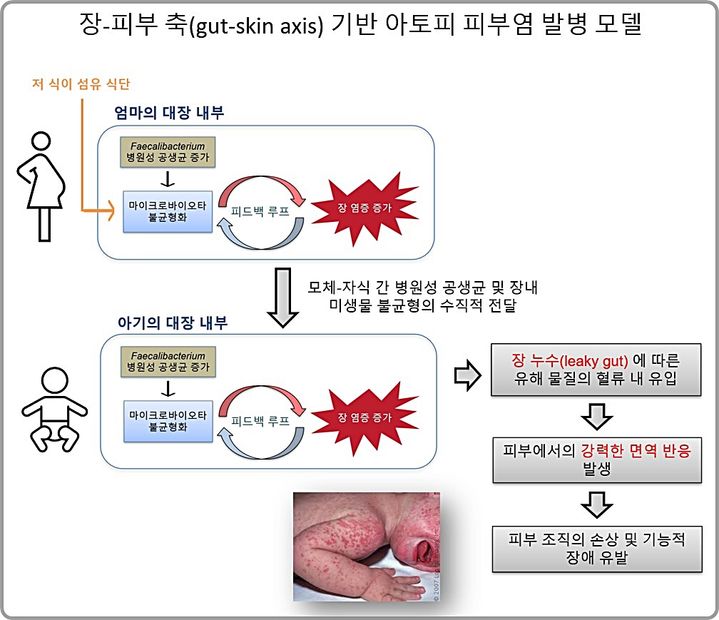 [대전=뉴시스] 고려대 김희남 교수팀이 피칼리박테리움(Faecalibacterium) 병원성 공생균(pathobiont)이 유익균보다 우세하고 모체의 식이섬유 섭취가 부족한 경우 장내 마이크로바이옴의 불균형이 심화된다는 사실을 규명했다.(사진=고려대 김희남 교수 제공) *재판매 및 DB 금지