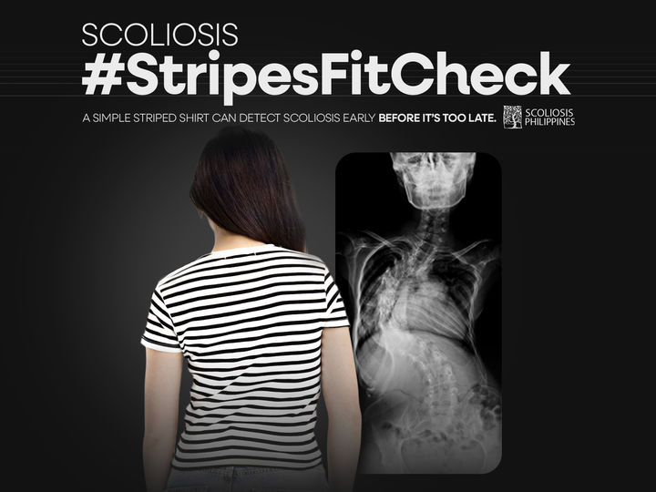 [부산=뉴시스] 부산국제마케팅광고제 '올해의 그랑프리' 공익광고 부문 수상작인 필리핀의 '척추측만증 #줄무늬 티셔츠로 체크해'. (사진=부산국제마케팅광고제 제공) 2025.08.29. photo@newsis.com *재판매 및 DB 금지