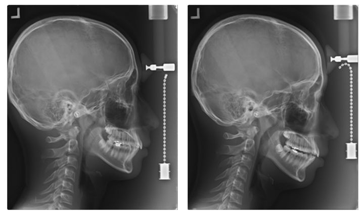 [서울=뉴시스] 1일 대한치과의사협회에 따르면 최근 안전 및 효과가 검증되지 않은 '셀프 치아장치' 사용으로 인해 오히려 구강 건강을 해치는 사례가 발생하고 있어 소비자의 각별한 주의가 요구되고 있다. 사진은 '셀프 치아장치' 로 인한 '턱관절 장애' 및 '부정교합' 유발 사례로 셀프 치아장치 장착 전(왼쪽)과 장착 후 모습이다. (사진=대한치과의사협회 제공) 2025.09.01. photo@newsis.com *재판매 및 DB 금지