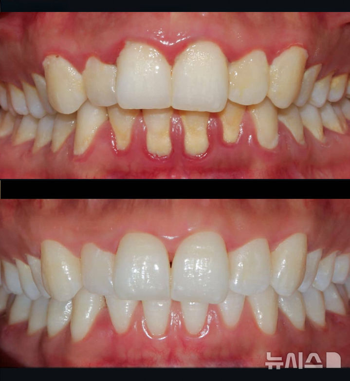 [서울=뉴시스] (위아래순) 치주질환 치료 전후 사진. (사진= 고대안산병원 제공) 