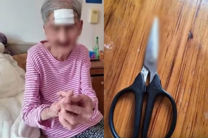 [서울=뉴시스] 중국의 98세 할머니가 이마 피부 뿔 종양을 스스로 가위로 제거해 응급수술을 받은 사연이 전해졌다. (사진 = SCMP 갈무리) 2025.09.02. *재판매 및 DB 금지