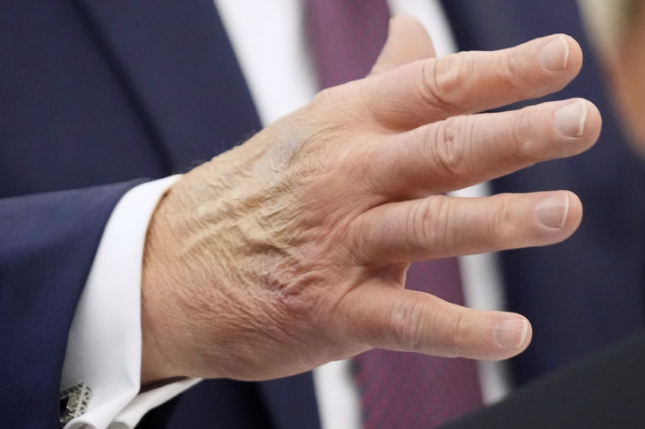 [워싱턴=AP/뉴시스] 도널드 트럼프 미국 대통령이 2일(현지 시간) 백악관 집무실에서 미 우주군사령부 본부 이전 계획을 발표하는 가운데, 오른손등에 멍든 자국이 선명하다. 트럼프 대통령은 자신을 둘러싼 건강 이상설을 일축했다. 2025.09.03.