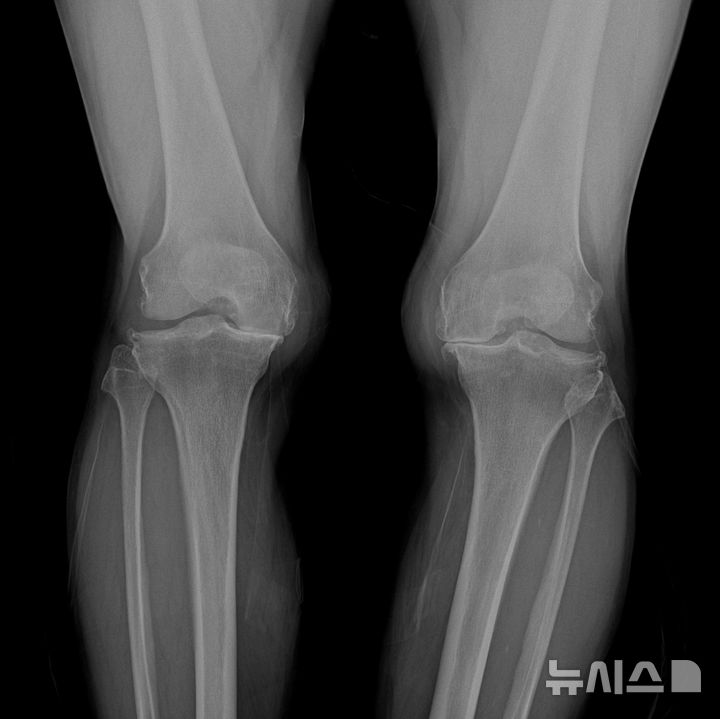 [서울=뉴시스] 퇴행성관절염 말기지만 인공관절 수술을 꺼리는 환자에게 냉각고주파 열치료술은 좋은 대안이 될 수 있다. (사진= 연세사랑병원 제공)