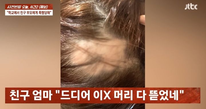 [뉴시스] 동급생 부모에게 집단 폭행 당한 제보자 딸의 상태. 2025.09.04. (사진=JTBC '사건반장' 갈무리) *재판매 및 DB 금지