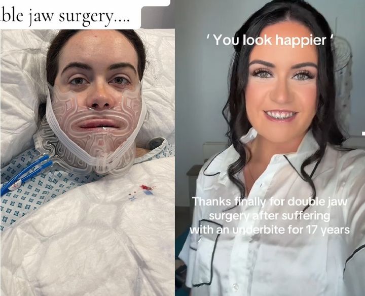 [뉴시스] 주걱턱으로 고통 받던 여성이 수술 이후로 자신감을 되찾은 모습. 2025.09.04. (사진=루이사 맥더모트 틱톡 캡처). *재판매 및 DB 금지