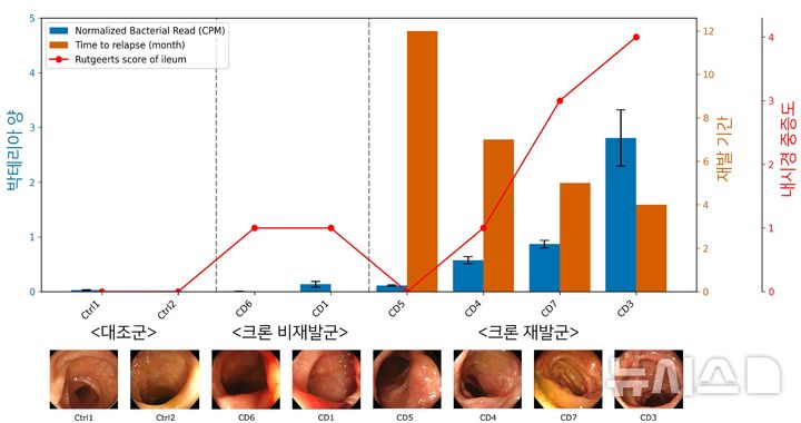 [서울=뉴시스] 크론병 환자의 장 조직을 분석한 결과, 크론병 장 조직에서 염증이 심한 부위에서 미생물의 분포가 크게 증가하는 것으로 나타났으며, 미생물의 분포 정도가 클수록 재발 기간이 짧고, 중증도가 큰 것으로 확인됐다. (사진= 연세의료원 제공)