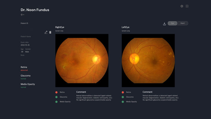 [서울=뉴시스] 의료 인공지능(AI) 메디웨일은 닥터눈 펀더스는 이번 승인을 계기로 비급여 시장에 진입하며, 선제적으로 시장에 자리 잡은 심혈관질환 예측 AI '닥터눈 CVD'와 더불어 메디웨일의 입지를 강화한다고 10일 밝혔다. (사진=메디웨일 제공) 2025.09.10. photo@newsis.com *재판매 및 DB 금지
