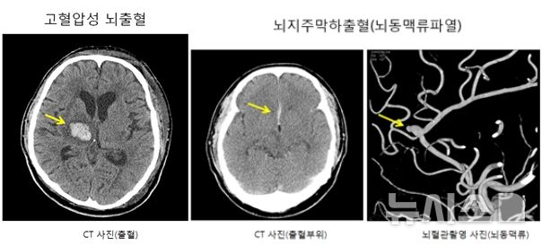[서울=뉴시스] 왼쪽부터 고혈압성 뇌출혈과 뇌지주막하출혈(뇌동맥류파열). (사진= 국민건강보험 일산병원 제공)